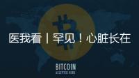 医我看丨罕见！心脏长在右胸膛
！珠海成功开展首例“右位心”房颤射频消融术